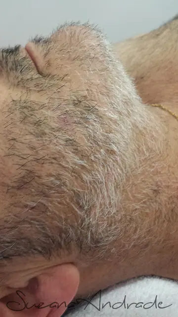 Barba e pescoço na depilação masculina